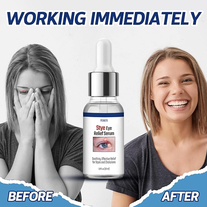 Stye Eye Treatment, Chalazion Treatment Serum, Stye & Blepharitis Remover with Hippophae Rhamnoides Fruit, Helichrysum Angustifolium Flower & Persea Gratissima Oil (1 Fl. OZ (Pack of 1))