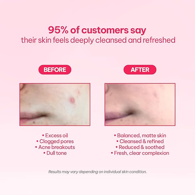 AC Clarifying Foam Cleanser 150ml/5.1 fl.Oz, Daily Facial Cleanser for Oily Skin, Unscented, Salicylic Cleansers, BHA, Korean Skincare