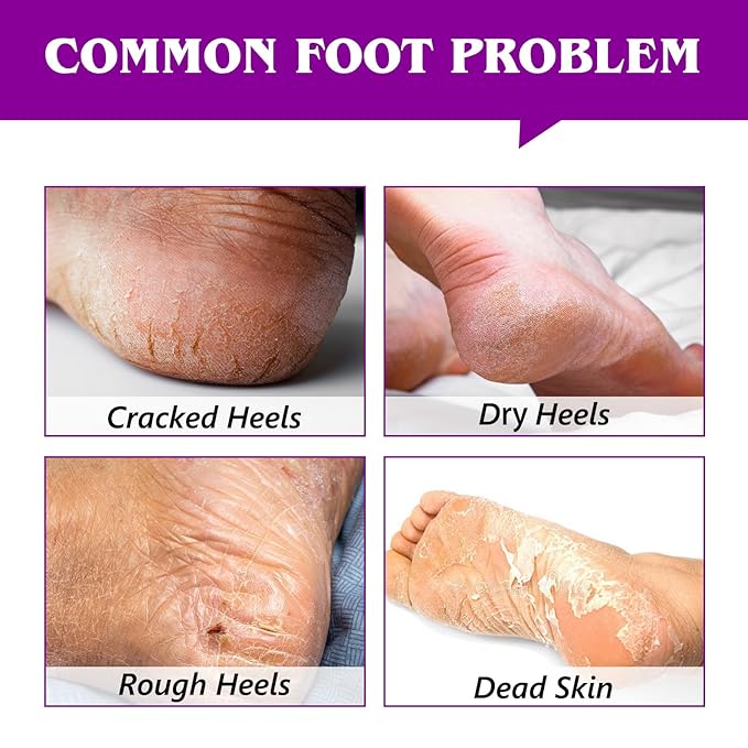 Cracked Heel Treatment Balm Stick, Dry & Cracked Foot Repair for Instant & Deep Moisturizing & Hydrating, with Aloe, Coconut Oil, Hyaluronic Aicd, Olive Oil, Lavender Scent, 2.46 oz/70 g