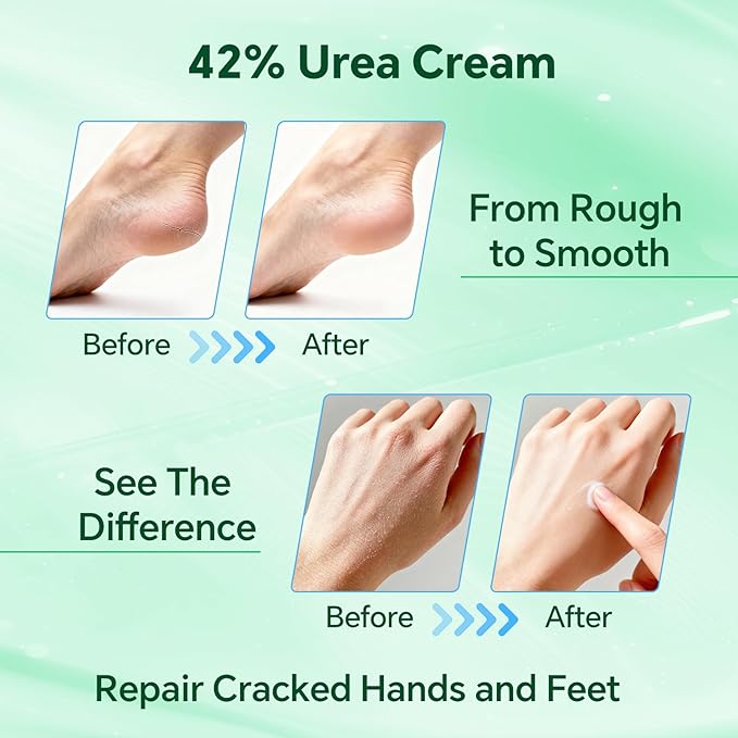 Professional 42% Urea Cream for Feet, Intense Moisturizer for Extremely Dry, Cracked Heels & Rough Skin, Callus Remover, Foot Softener Treatment, Safe Cracked Heel Repair (1)