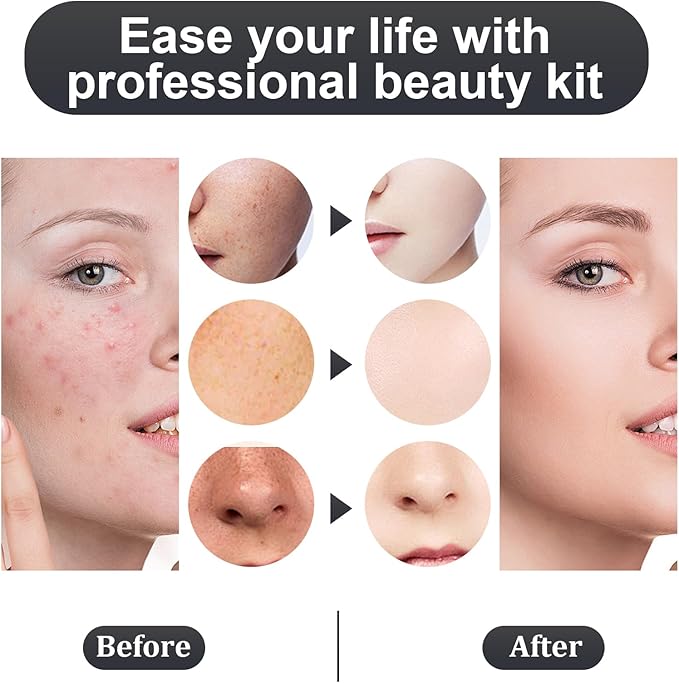 6PCS Blackhead Remover Comedone Extrator Kit, Pimple Extractor Acne Removal Tool Kit, Curved Blackhead Tweezers Kit, Comes with Alcohol Tablets and Magnifying Glasses for Blemish Removal (Iron Box)