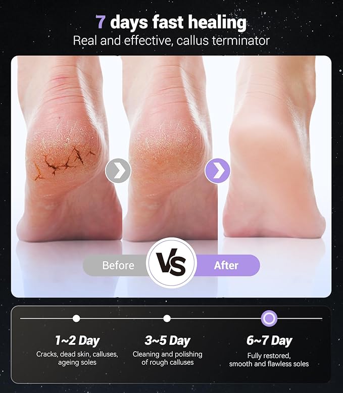 5-in-1 Professional Electric Callus Remover(Portable & Foldable), Removes 99.92% of Calluses in 3 Mins, Rechargeable Foot File Pedicure Kits with 10 & 40 Grit Pads for Soft Smooth Feet, Purple
