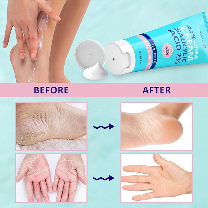 Urea Cream 42% - Foot Care for Dry Cracked Heels, Foot Lotion - With 2% Salicylic Acid, Tea Tree Oil, Shea Butter, Aloe Vera - For Feet, Hands, Heels, Elbows, Knees and More - 4 oz