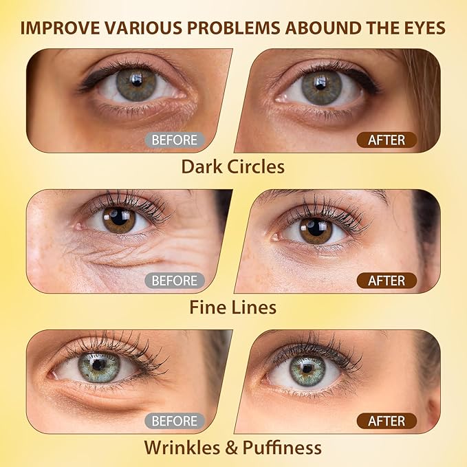 Eye Serum with 5% Caffeine, Retinol, Niacinamide & Hyaluronic Acid - Anti-Aging Treatment Balms for Dark Circles, Puffiness, Wrinkles & Bags - Under Eye Brightening & Firming Cream