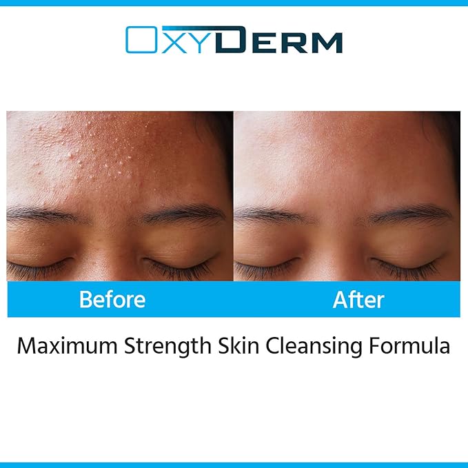 Acne Face wash Treatment with Benzoyl Peroxide 5% - Clinically Proven Wash to Fight Acne Blemishes on Contact. Eliminates Cystic Breakouts, Oily Skin, Clogged Pores, Blackhead, Whitehead, & Pimples.