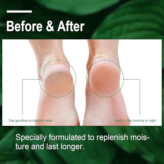 Urea Cream 40 Percent For Feet Maximum Strength, Plus 2% Salicylic Acid with Hyaluronic Acid, Urea Foot & Hand Cream for Dry Cracked, 4.6 oz