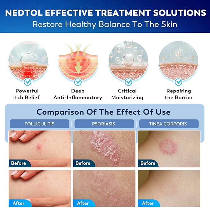 Folliculitis Treatment Cream, 7X Fast-Acting Antibacterial Ointment for Scalp, Face & Body, Relieves Itching, Redness & Bumps, Intensive Skin Therapy – 120g