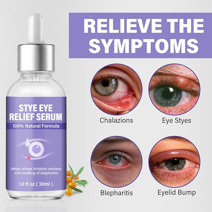 Stye Eye Treatment, Eye Reflief Serum for Styes and Chalazions, Natural & Non-Irritating, Fast-Acting Soothing and Restores Healthier Skin, 30ml