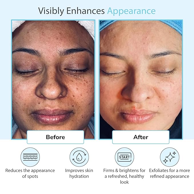 Glycolic Acid 50% Gel Peel - Enhanced with Retinol & Green Tea Extract (Professional Skin Peel)1 ounce