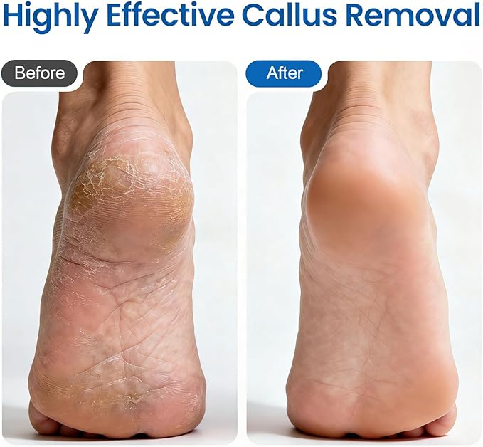 Electric Foot Callus Remover-60pcs Replacement Sandpaper Discs, 1200RPM Speed Adjustment, Metal Body, Callus & Dead Skin Removal