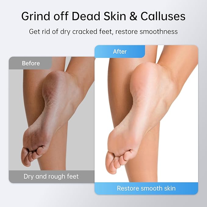 Electric Foot Callus Remover Rechargeable, 6 Speeds Adjustable USB Charging Foot Sander, Portable Electric Foot File Professional Foot Grinder for Dead Skin & Cracked Heel