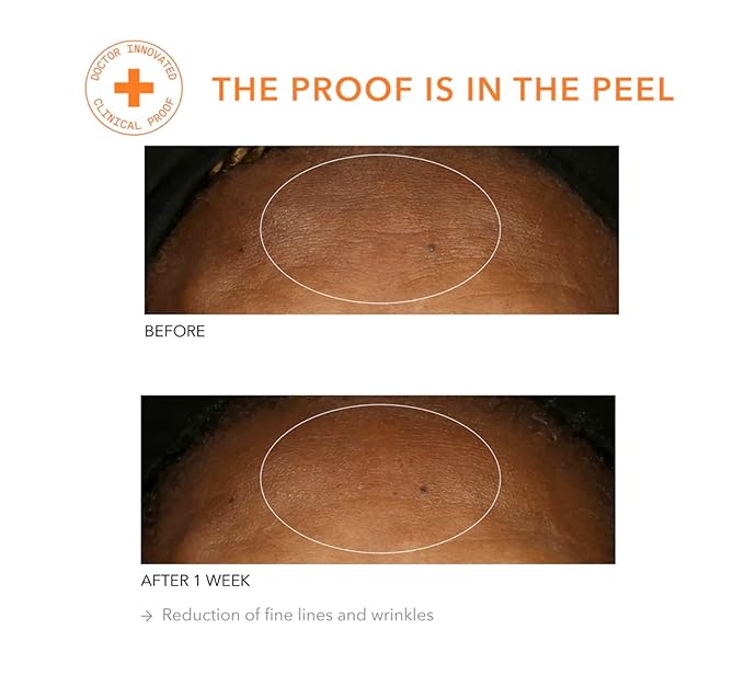 Dr Dennis Gross Alpha Beta Universal Daily Peel: for Uneven Tone or Texture and Fine Lines or Enlarged Pores, (5 Treatments)