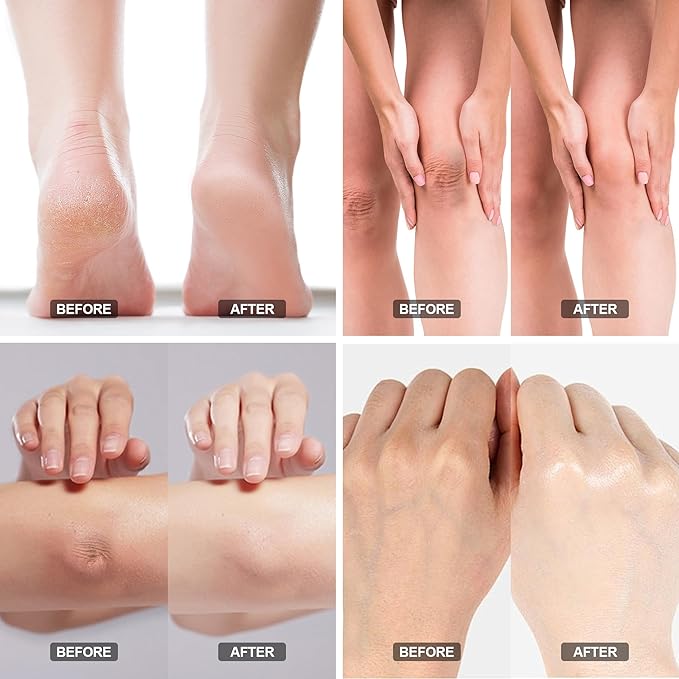 Urea Cream 40% - Foot Care for Dry Cracked Heels, Foot Lotion - With 2% Salicylic Acid, Tea Tree Oil, Shea Butter, Aloe Vera - For Feet, Hands, Heels, Elbows, Knees and More - 6 oz