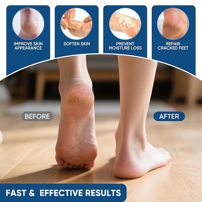 Urea Cream 40% Plus Salicylic Acid 2%, Urea Cream 40 Percent for Feet Maximum Strength, Foot Cream for Dry Heels Cracked (2 PCS)