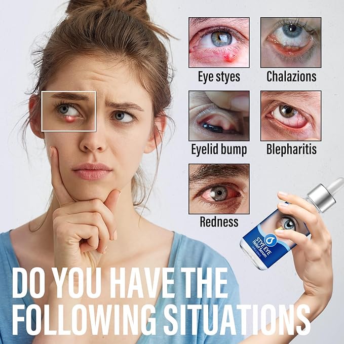 Stye Eye Treatment, Stye Relief Serum, Non-Irritating Formula, Immediatelty Relieve Eye Redness & Swelling, Target Chalazions & Blepharitis (1 Fl. OZ)