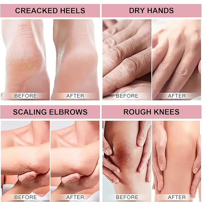 42% Urea Cream with 2% Salicylic Acid, Hand and Foot Cream Stick for Hydrates and Repairs Rough, Dry, Thick & Cracked Skin, Callus Remover, Soothing Skin Care for Women and Men 1.41oz