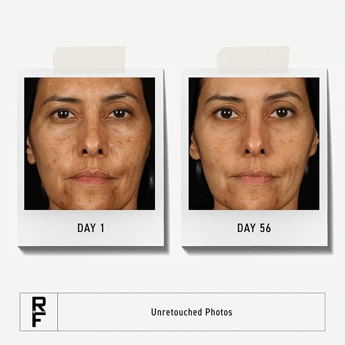 Rodan + Fields Multi-Acid Enzyme Peel | 30 ml | Formulated with Glycolic Acid & Salicylic Acid | Ideal for Uneven Skin Tone | Skin Care | Exfoliating Leave on Face Mask