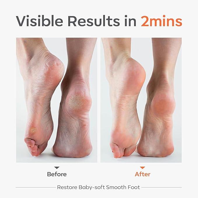 Modelones Glass Foot File, Professional Foot Scrubber and Callus Remover, Heel Scraper for Cracked Heels, Dead Skin Remover, Foot Buffer for Soft Feet, Safe Pedicure Tool with Anti-Slip Handle