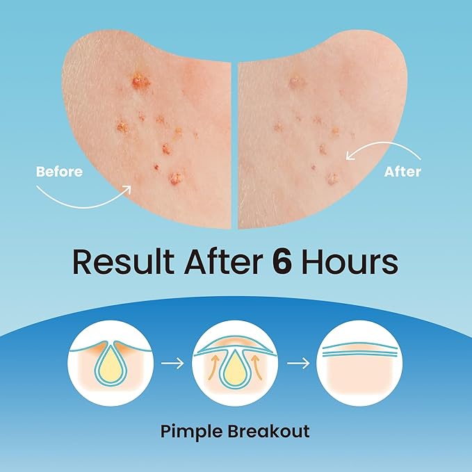 Ultra Invisible Dark Spot Patches & Large Pimple Patches Bundle for Post Acne Treatment – Day & Night Use, Hydrocolloid & Salicylic Acid Zit Stickers for Nose, Chin & Forehead – 96 + 16 Count Bundle