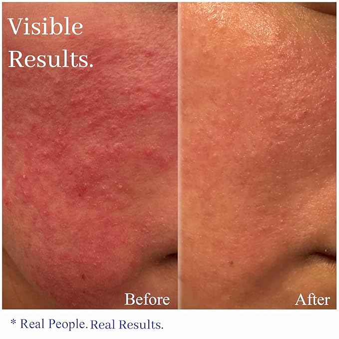 Hey Honey Skincare Relax - Instant Rosacea Relief Cream for Sensitive Skin | Calming Face Moisturizer for Facial Redness & Irritation | Dermatologist Tested, Oil-Free with Honey & Propolis | 2.2 Oz