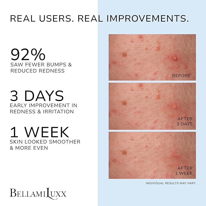 Folliculitis Acne Lotion for Body: Helps Reduce Itch, Redness, Body Acne, Bumps & Uneven Texture with Salicylic & Glycolic Acid + Botanicals - Gentle Care for Folliculitis-Prone Skin