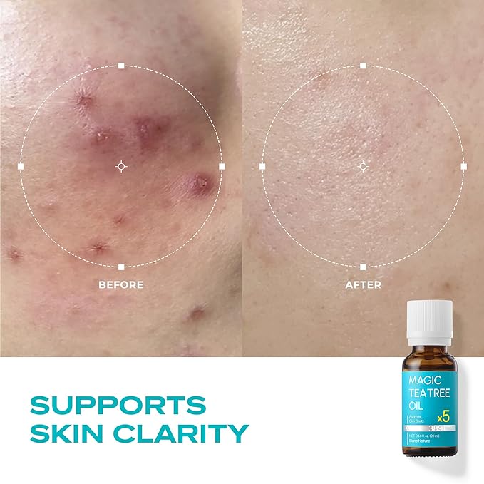 – Magic Tea Tree Oil for Face, Clarifying Facial Oil for Oily & Sensitive Skin, Lightweight Daily Care with Tea Tree, Skin-Balancing Vegan Korean Skincare, 0.7 fl oz