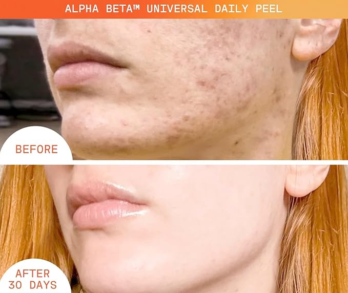 Dr Dennis Gross Alpha Beta Universal Daily Peel: for Uneven Tone or Texture and Fine Lines or Enlarged Pores, (5 Treatments)