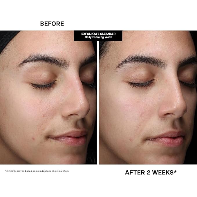 Kate Somerville Pore-fect Skin Edit Travel Kit : ExfoliKate, EradiKate, & Goat Milk Cleanser Holiday Gift Set