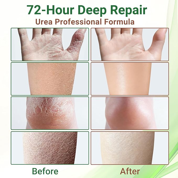 ishancare Moisturizing & Repair Cream with Urea – Intensive Treatment for Extremely Dry, Cracked Skin – Soothes Rough Hands & Heels – 200g Jar