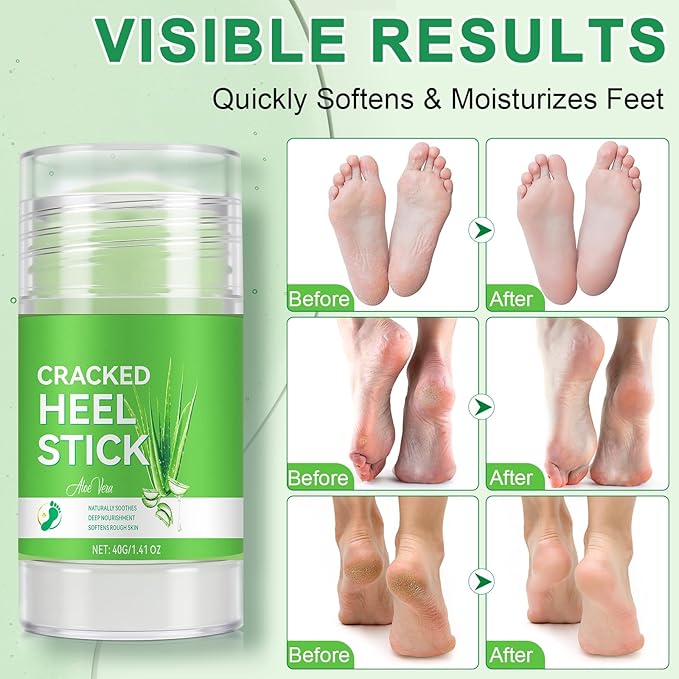 Urea Cream 60% Plus Salicylic Acid 2% Foot Balm Stick for Dry Cracked/Chapped Heel, Skinned knees, Hand Intensively Hydration/Moisturization, Callus Removal/Softening/Soothing-Aloe Scent|1.41 Oz/40 G