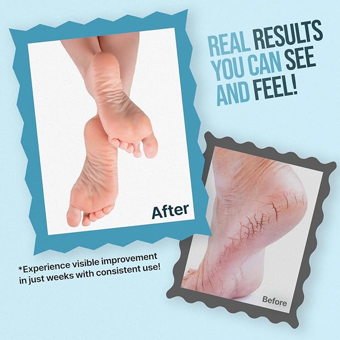 Free Life Labs - Urea Cream for Feet - Maximum Strength 42% Foot Cream for Calluses and Dry Feet - Free Pumice Stone and Brush - Shea and Mango Butters-Paraben Free-Fragrance Free- 4oz.