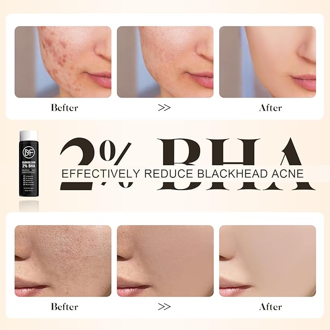 2% BHA Salicylic Acid Liquid Exfoliant Serum For Blackhead Removal,Unclog Pores,Smooths skin118mL 4 fl OZ Face Exfoliator For Facial Skin Care