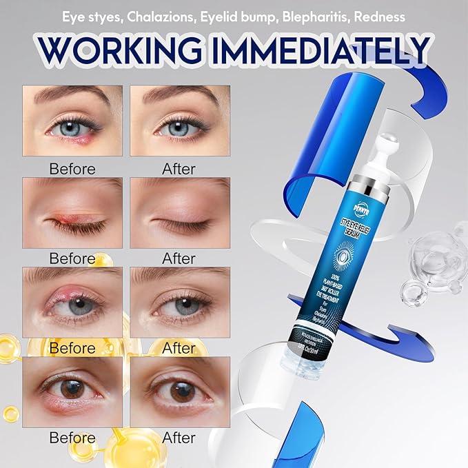 Stye Eye Treatment, Multi-Effect Eye Serum, Chalazion Soothing Care Drops with 360° Massage Rollerball - Moisture & Botanical Extract Formula, Cruelty-Free (1 Fl Oz (Pack of 1))