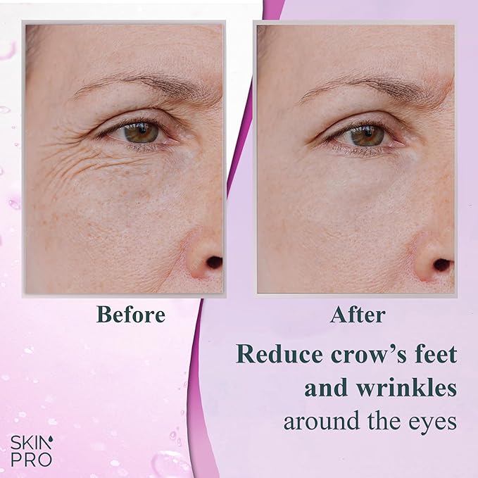 SkinPro Elite Serum 10 - Natural Anti Aging Eye Serum and Anti Wrinkle Treatment - Eye Bags and Dark Circles Remover with Advanced Formulation of Hyaluronic Acid, Collagen, Argireline and Peptides