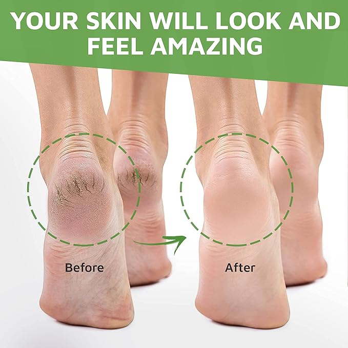 Activelife - Urea Cream 40 Percent for Feet, Formulated by Doctors, Foot Cream for Dry Cracked Heels, Foot Callus Remover, Rehydrates Dry, Rough, Dead Skin on the Feet, Hands, and Elbows, Free Pumice