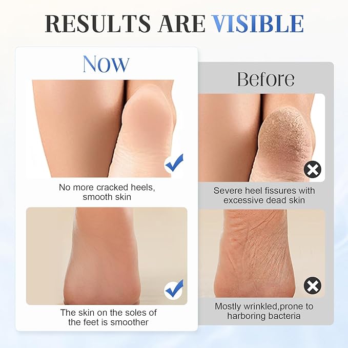 Hydrating and Anti-Cracking Foot Cream, 2025 Moisturising and Relieves Cracking and Dryness Foot Cream, Hand and Foot Repair Cream for Women & Men Callused, Feet, Knee, Elbow, Hand (BU-1PC, #01)