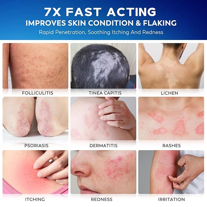 Folliculitis Treatment Cream, 7X Fast-Acting Antibacterial Ointment for Scalp, Face & Body, Relieves Itching, Redness & Bumps, Intensive Skin Therapy – 120g