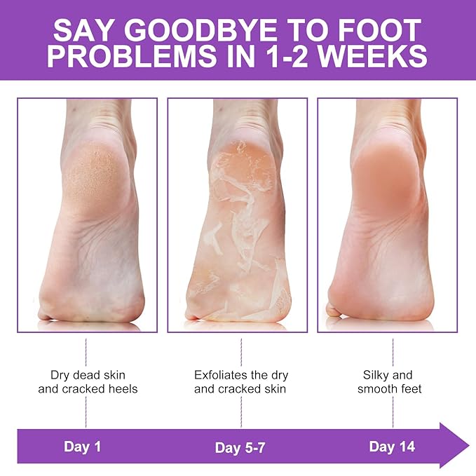 Foot Peeling Mask 5 Pack, Foot Peel Mask Remove Dead Skin, Rough Callus and Cracked Heels, Dry Skin Moisturizer for Soft and Smooth Baby Touch Feet (Lavender)