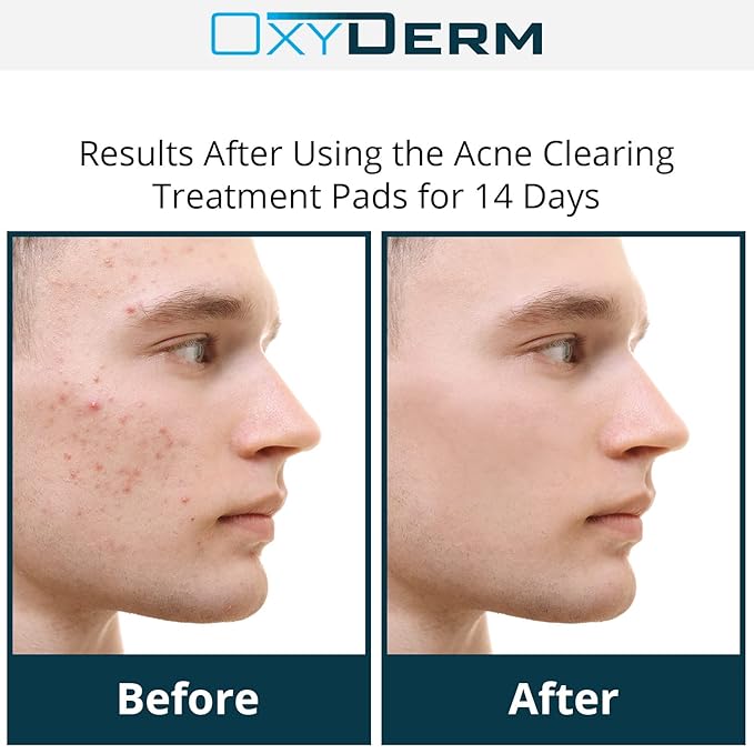 Acne Treatment Pads- Eliminates Pimple, Whitehead, blackhead, & Cystic Breakouts. Clear Clogged Pores, Oily Skin, Blemish, Dark Spots & Improve Skin Texture. 60 count