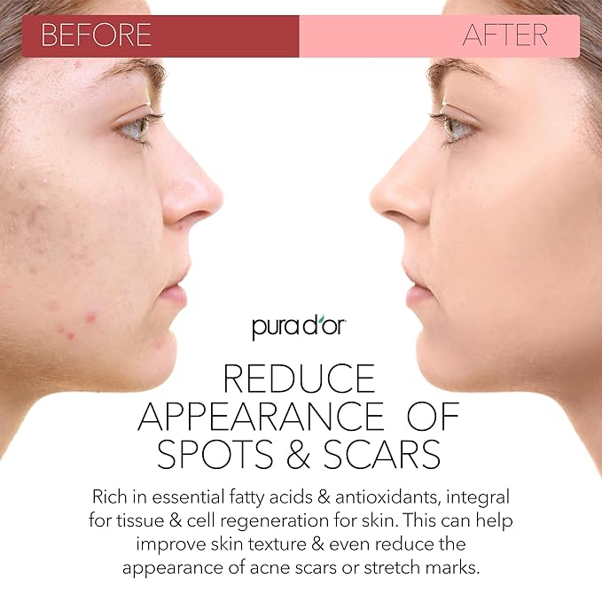 PURA D'OR ORGANIC Rosehip Seed Oil Hair Relaxer (4 Oz x3 = 12 Oz) 100% Pure Cold Pressed USDA Certified All Natural Anti-Aging, Scar Treatment, Gua Sha Massage, Face, Hair & Skin - Women & Men