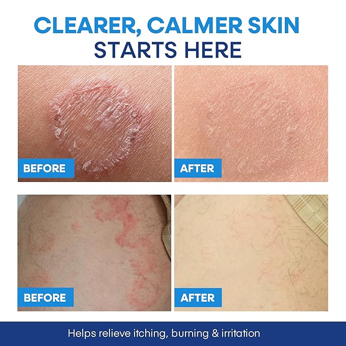 Hermon Antifungal Body Wash for Jock Itch: Tea Tree oil Body Wash for Jock Itch, Ringworm, Back Acne, Athlete's Foot, Tinea - Medicated Soap for Men and Women