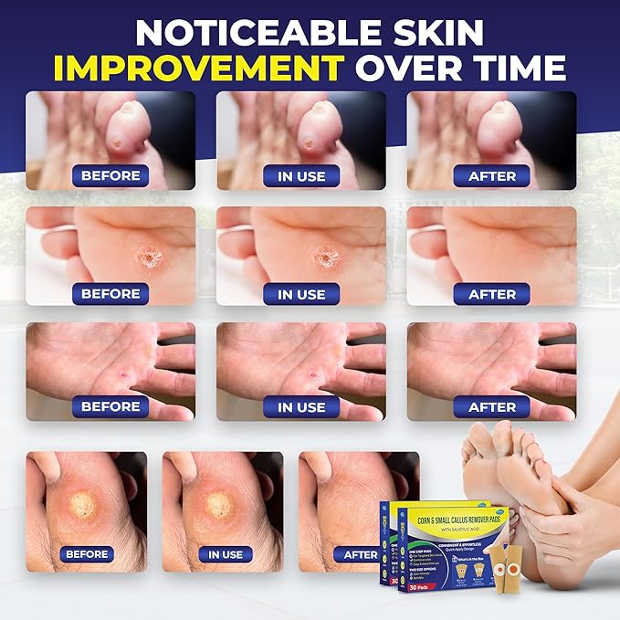 Corn Remover Pads for Feet Toes: 2 Boxes of 30 Pack Salicylic Acid Extra Strength Treatment - Fast Effective Medicated Bandages for Kids Adults Seniors Teens Runners Workers Men Women 60 Blue