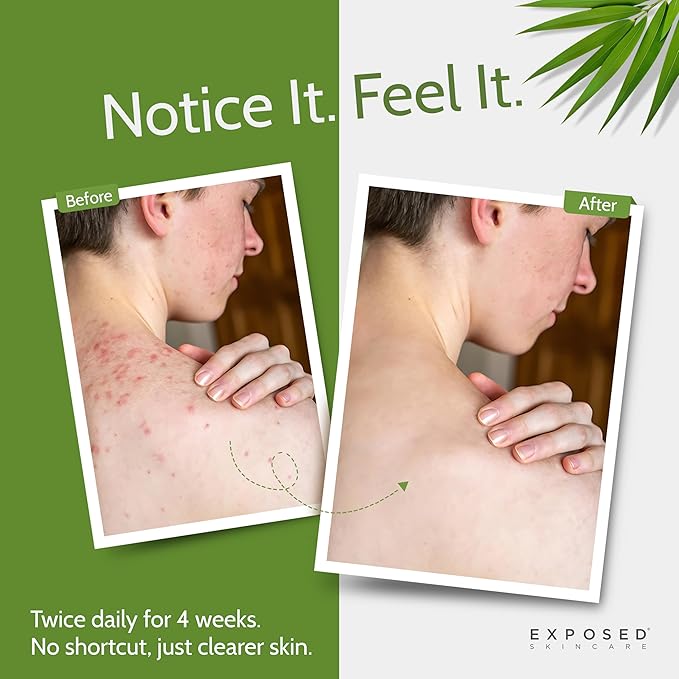 Exposed Skin Care, Body Acne Wash with Salicylic Acid, Glycolic Acid and Tea Tree Oil – Tri-Powered Gentle Exfoliating Cleanser for Back, Chest and Body Acne – Natural, Non-toxic and Cruelty Free