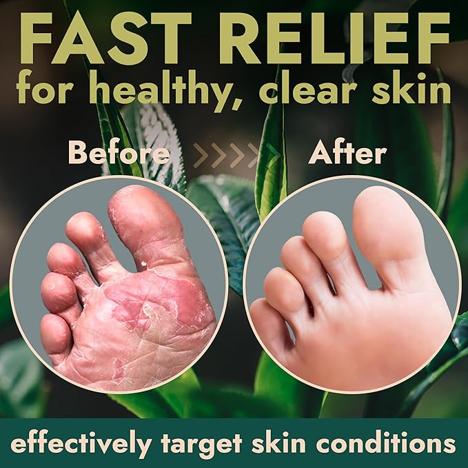 Terramed Just Think Comfort Foot Spray with Tea Tree Oil | Antifungal Treatment for Jock Itch, Nail Fungus & Ringworm | Fast Absorbing & Deep Penetrating Relief | Soothes Itching & Burning | 120ml