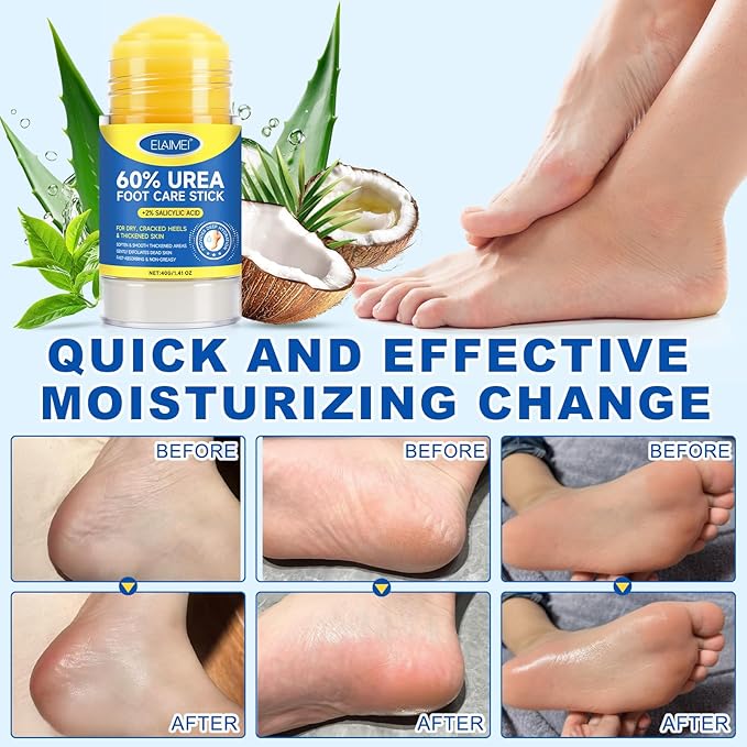Urea Foot Cream Stick, Urea Cream 60 Percent for Feet Maximum Strength, Foot Cream for Cracked Heels and Dry Skin, Cracked Heel Repair Cream, Foot Moisturizer, 1.41 Oz