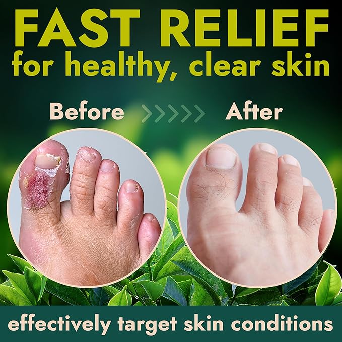 Antifungal Foot Powder with Miconazole Nitrate 2% & Tea Tree Oil for Foot Fungus Treatment | Soothes Itchy Skin, Controls Odor & Prevents Reinfection | Powder for Athlete’s Foot Relief | Pack of 3