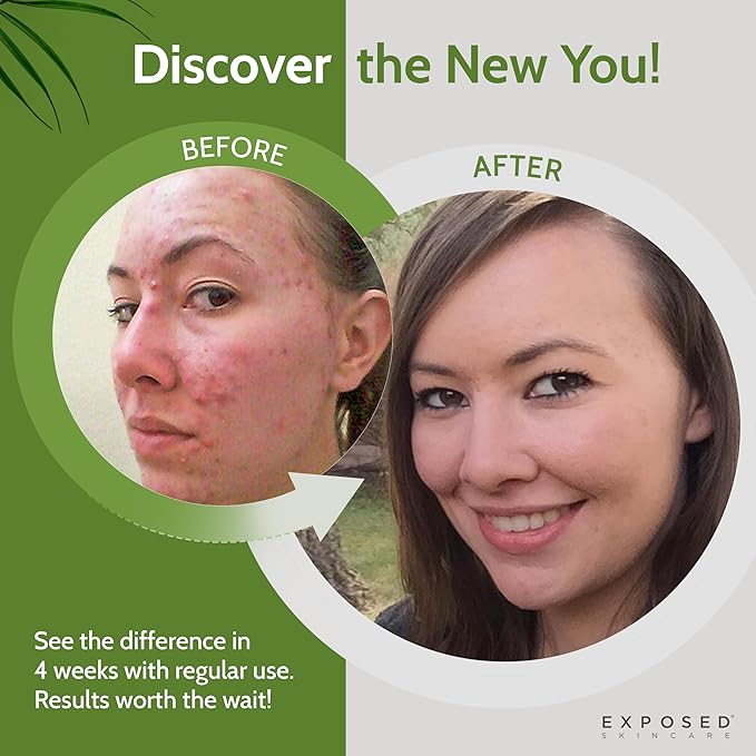 Exposed Skin Care, Clearing Tonic Facial Toner with 1% Salicylic Acid and Witch Hazel – Daily Toner for Teen and Adult Acne, Blackheads and Oily Skin – Natural, Non-Toxic and Cruelty Free