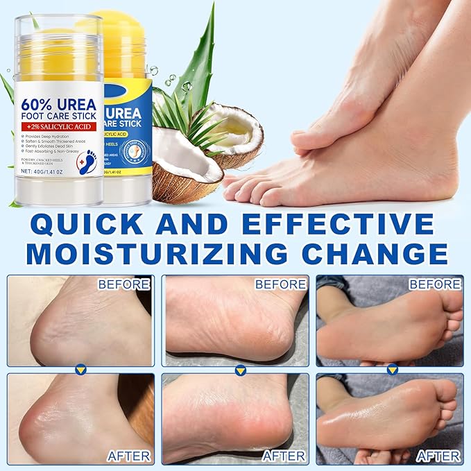 2 Pcs 60% Urea with 2% Salicylic Acid Foot Care Stick, Urea Foot Cream for Cracked Feet, Repairs Dry Rough Heels Fast, Foot Lotion Moisturizer for Dead Skin, Hydrating Heel Balm