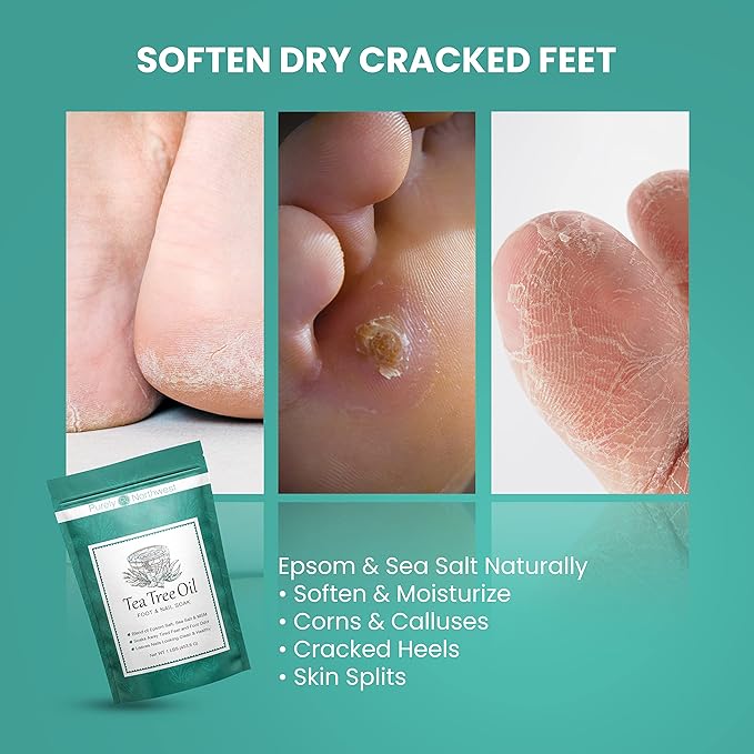 3 Pounds-Tea Tree, Peppermint, Foot Soak | MSM with Epsom Salt Soothes Burning & Itching from Athletes Foot & Foot Odors-Softens Dry Calloused Heels Made by Purely Northwest