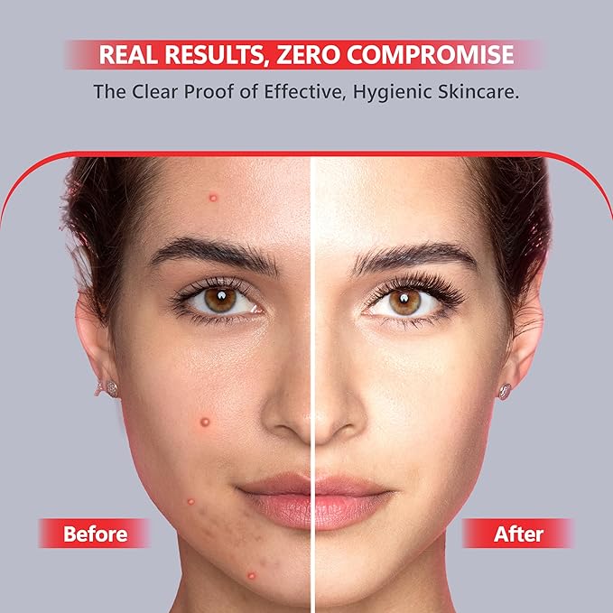 Suvorna White Head Remover for Face, Pimple Extractor, Pimple Popper, Whitehead Remover for Face, Comedone Extractor Tool, Pimple Extractor Tool, Pimple Popper Tool